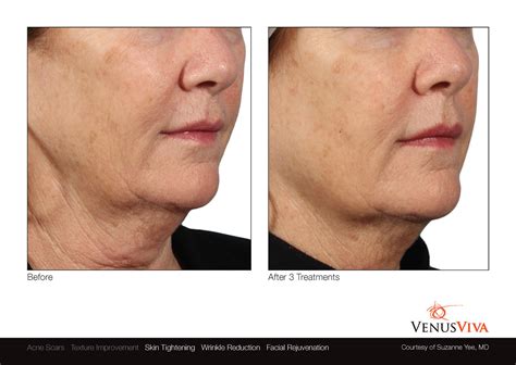 venus viva miami|Venus Viva wrinkle treatment before & after photos.
